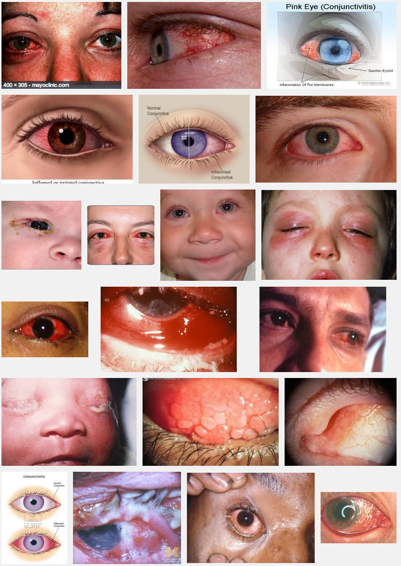 pink-eye